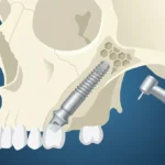Pterygoid Implants